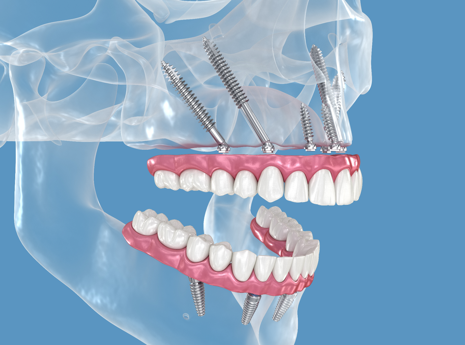 3D illustration of four zygomatic implants anchored in the cheekbone supporting an upper full-arch dental prosthesis
